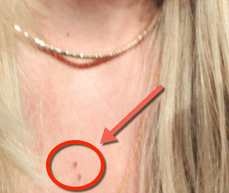 Closeup of Jennifer Lawrence's red chest moles